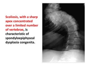 Scoliosis, with a sharp
apex concentrated
over a limited number
of vertebrae, is
characteristic of
spondyloepiphyseal
dysplasia congenita.
 