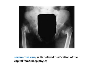 severe coxa vara, with delayed ossification of the
capital femoral epiphyses
 