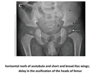 horizontal roofs of acetabula and short and broad iliac wings;
delay in the ossification of the heads of femur
 