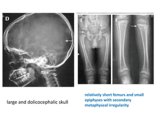 large and dolicocephalic skull
relatively short femurs and small
epiphyses with secondary
metaphyseal irregularity
 