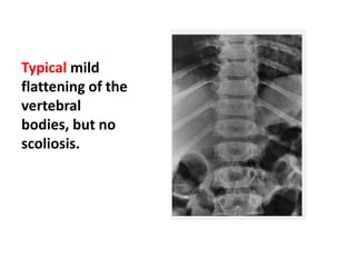 Typical mild
flattening of the
vertebral
bodies, but no
scoliosis.
 