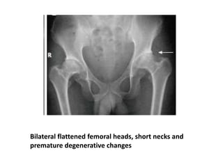 Bilateral flattened femoral heads, short necks and
premature degenerative changes
 