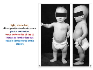light, sparse hair,
disproportionate short stature
pectus excavatum
varus deformities of the LL
increased lumbar lordosis
flexion contractures of the
elbows
 