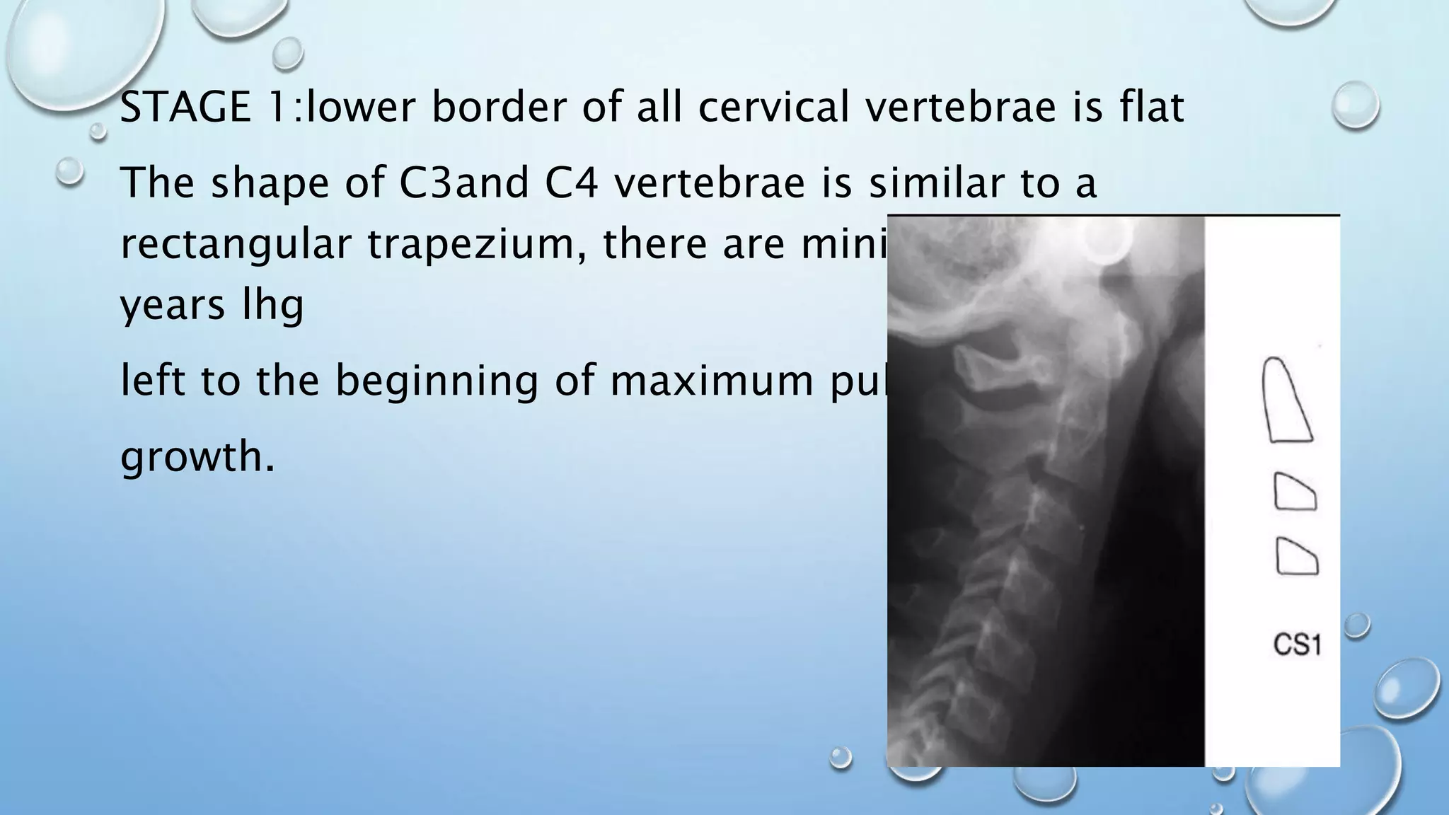 STAGE 1:lower border of all cervical vertebrae is flat
The shape of C3and C4 vertebrae is similar to a
rectangular trapezium, there are minimum 2 or more
years lhg
left to the beginning of maximum pubertal
growth.
 
