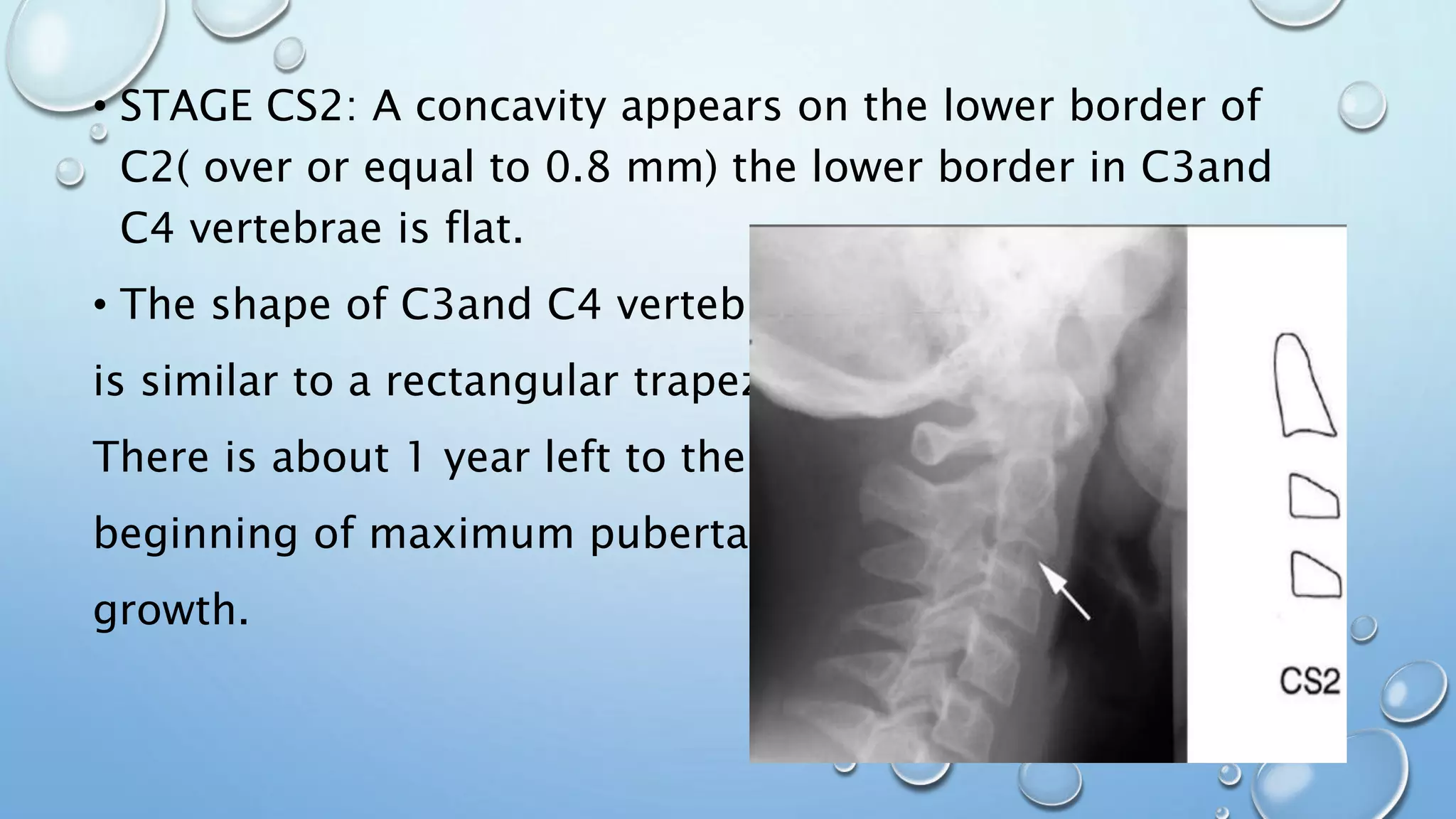 • STAGE CS2: A concavity appears on the lower border of
C2( over or equal to 0.8 mm) the lower border in C3and
C4 vertebrae is flat.
• The shape of C3and C4 vertebrae
is similar to a rectangular trapezium.
There is about 1 year left to the
beginning of maximum pubertal
growth.
 