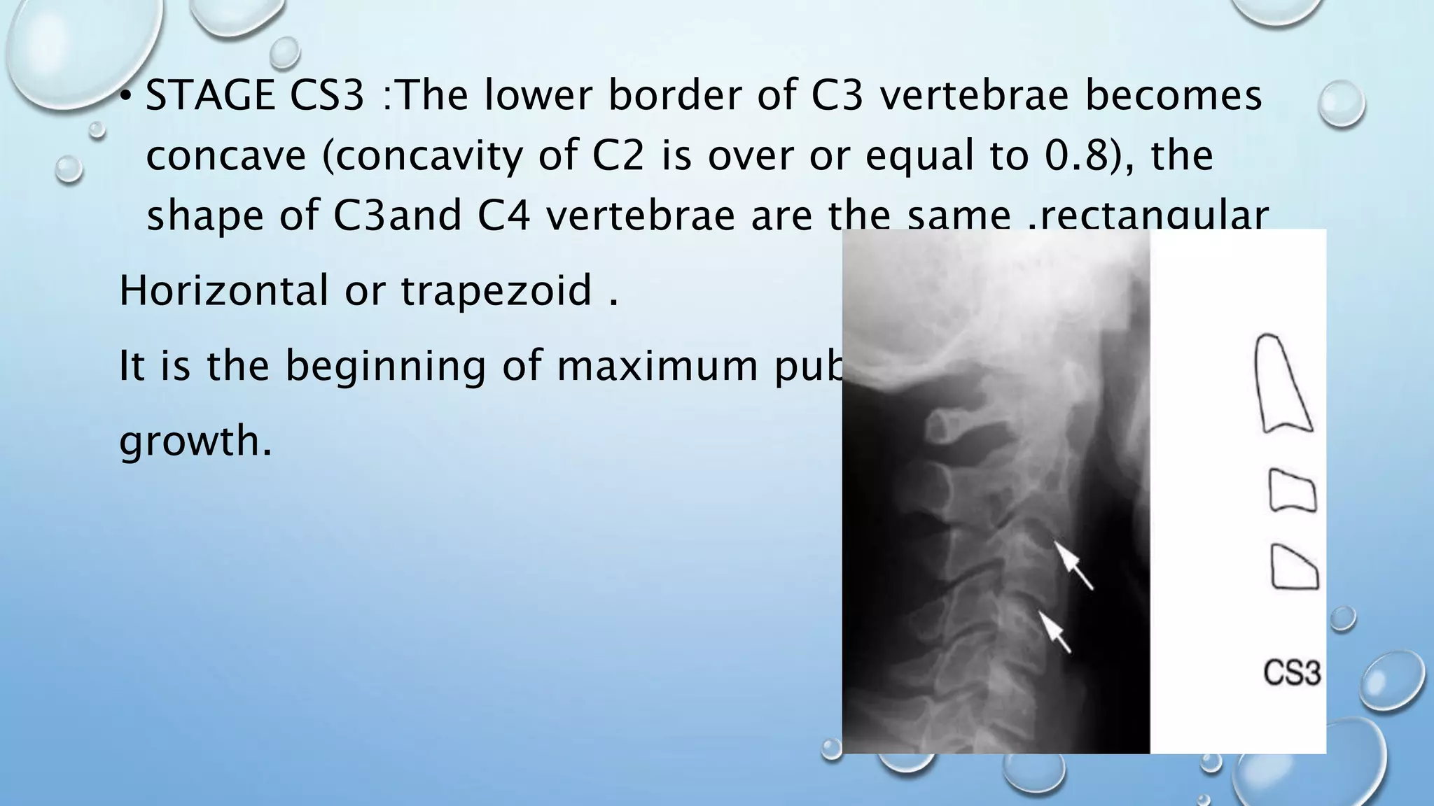 • STAGE CS3 :The lower border of C3 vertebrae becomes
concave (concavity of C2 is over or equal to 0.8), the
shape of C3and C4 vertebrae are the same ,rectangular
Horizontal or trapezoid .
It is the beginning of maximum pubertal
growth.
 