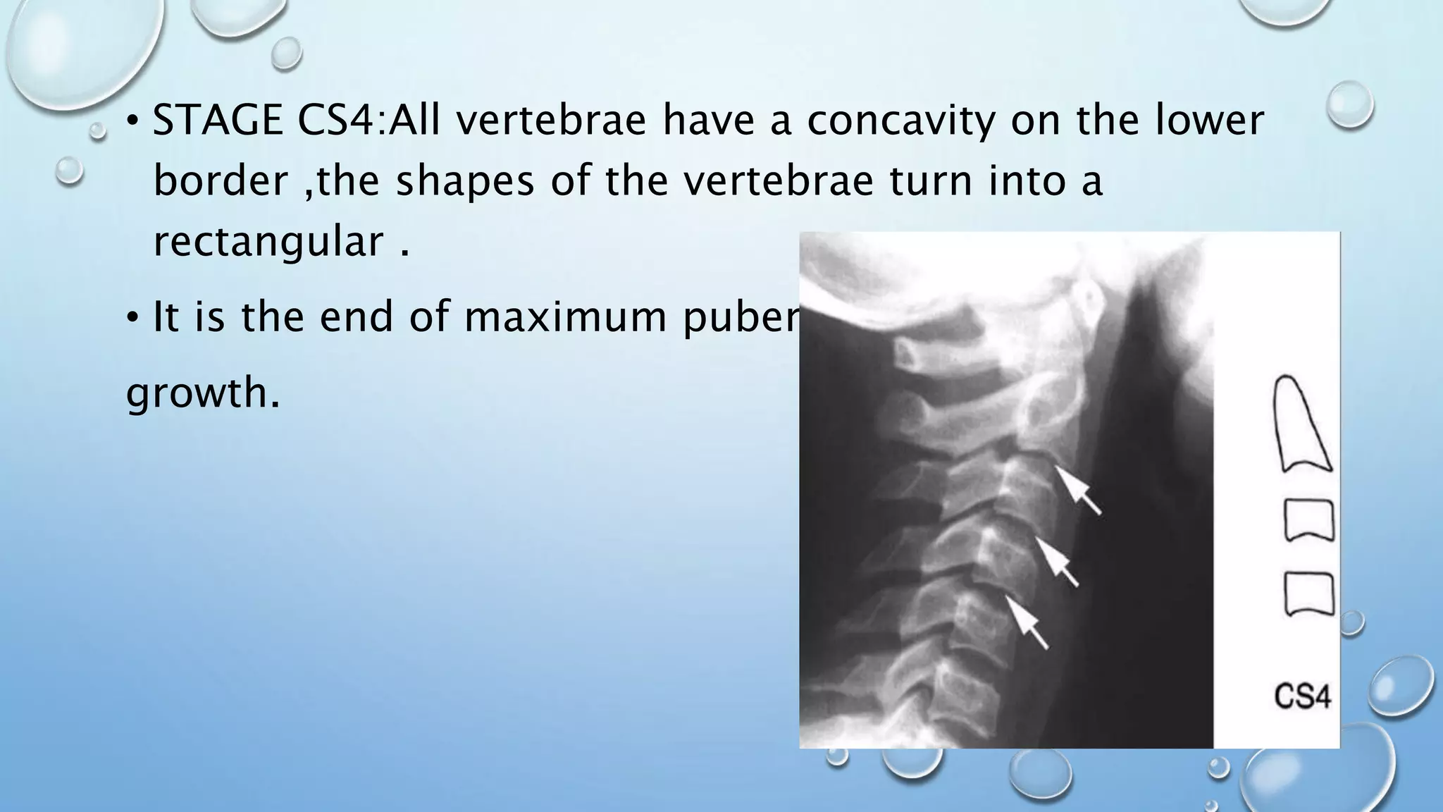 • STAGE CS4:All vertebrae have a concavity on the lower
border ,the shapes of the vertebrae turn into a
rectangular .
• It is the end of maximum pubertal
growth.
 