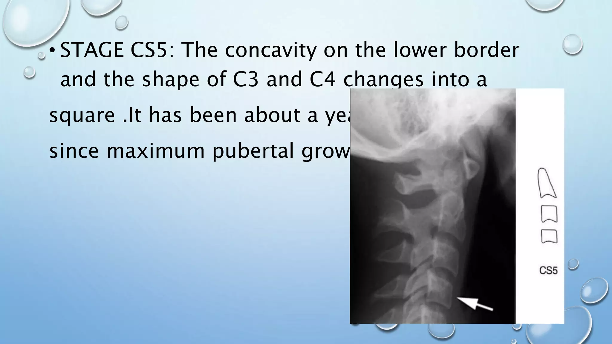 • STAGE CS5: The concavity on the lower border
and the shape of C3 and C4 changes into a
square .It has been about a year
since maximum pubertal growth.
 