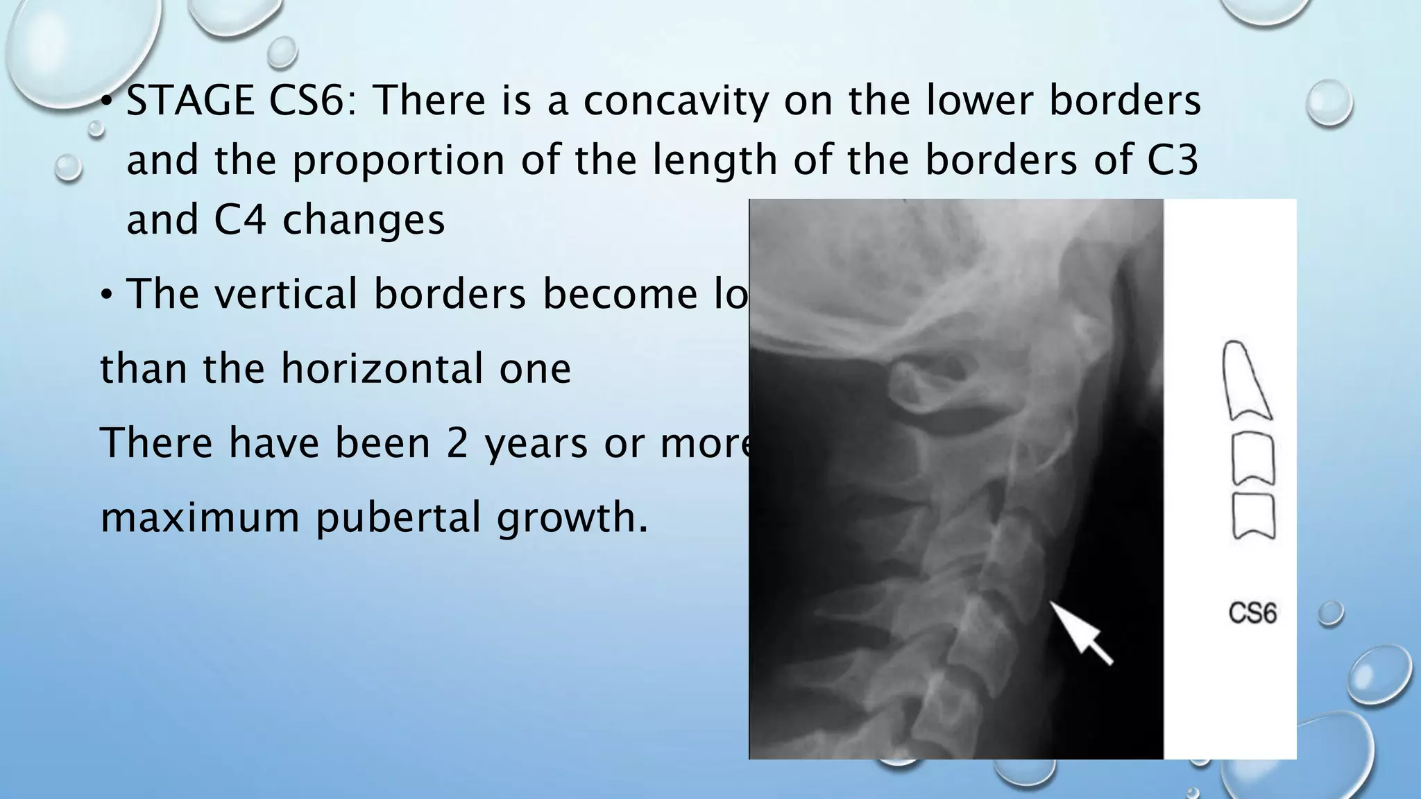 • STAGE CS6: There is a concavity on the lower borders
and the proportion of the length of the borders of C3
and C4 changes
• The vertical borders become longer
than the horizontal one
There have been 2 years or more since
maximum pubertal growth.
 