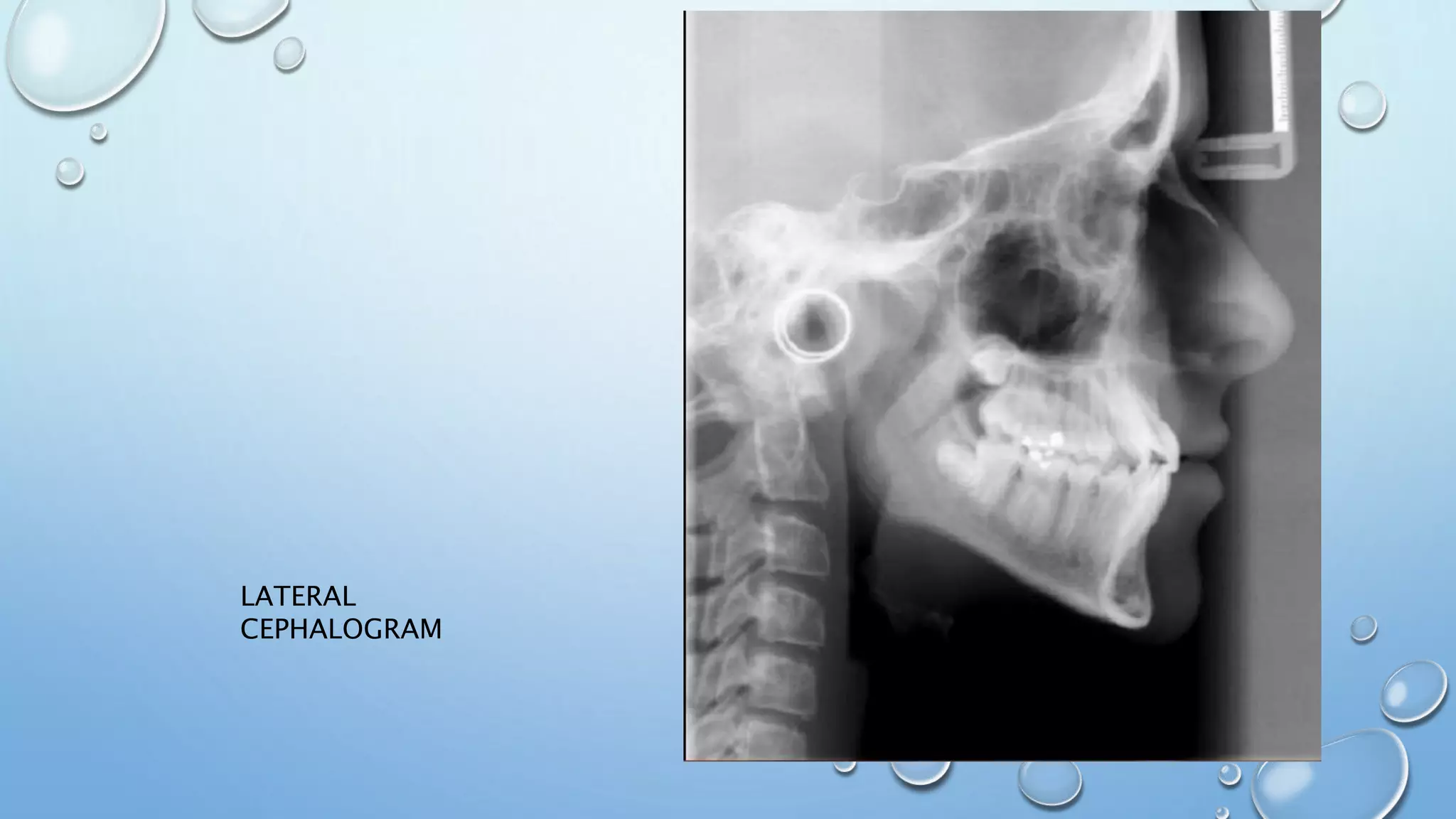 LATERAL
CEPHALOGRAM
 