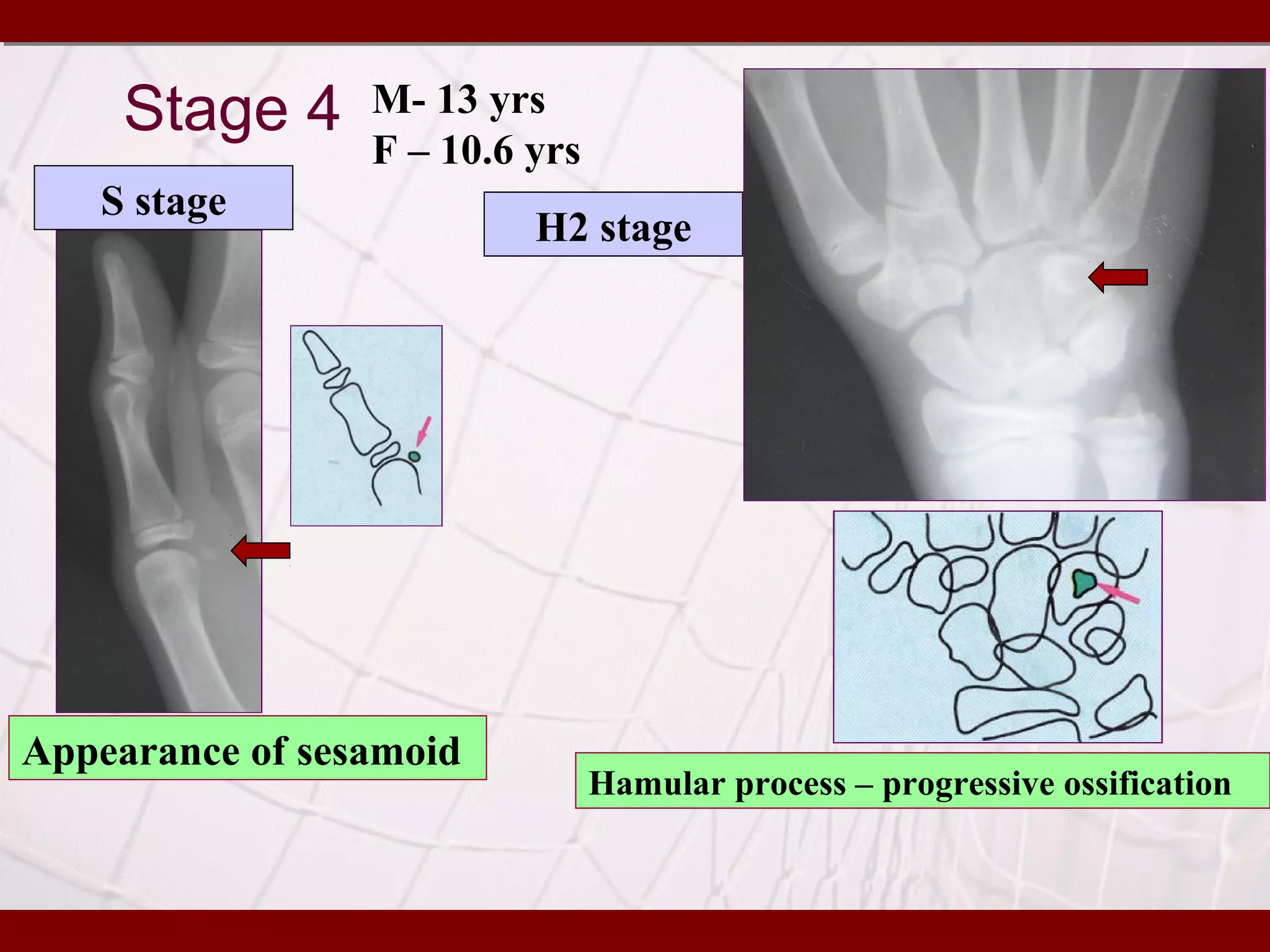 Skeletal maturity indicators | PPT