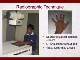 Radiographic Technique
• Source to subject distance
– 64cm
• O° Angulation,without grid
• 46Kv, 6.5mAmp, 0.4Sec
 