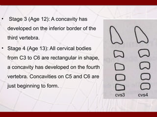 • Stage 3 (Age 12): A concavity has
developed on the inferior border of the
third vertebra.
• Stage 4 (Age 13): All cervical bodies
from C3 to C6 are rectangular in shape,
a concavity has developed on the fourth
vertebra. Concavities on C5 and C6 are
just beginning to form.
 