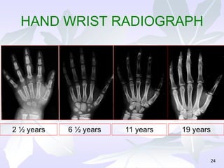24
2 ½ years 6 ½ years 11 years 19 years
HAND WRIST RADIOGRAPH
 