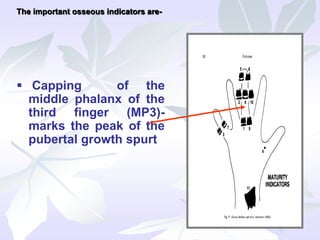  Capping of the
middle phalanx of the
third finger (MP3)-
marks the peak of the
pubertal growth spurt
The important osseous indicators are-
 