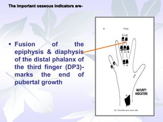  Fusion of the
epiphysis & diaphysis
of the distal phalanx of
the third finger (DP3)-
marks the end of
pubertal growth
The important osseous indicators are-
 