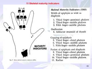 33
11 Skeletal maturity indicators
 
