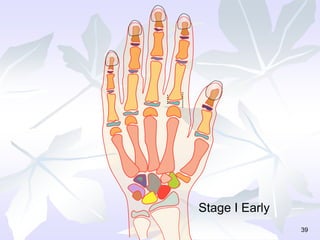 39
Stage I Early
 
