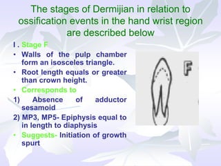 The stages of Dermijian in relation to
ossification events in the hand wrist region
are described below
I . Stage F
• Walls of the pulp chamber
form an isosceles triangle.
• Root length equals or greater
than crown height.
• Corresponds to
1) Absence of adductor
sesamoid
2) MP3, MP5- Epiphysis equal to
in length to diaphysis
• Suggests- Initiation of growth
spurt
 
