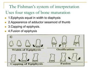 The Fishman’s system of interpretation
Uses four stages of bone maturation
 1.Epiphysis equal in width to diaphysis
 2.Appearence of adductor sesamoid of thumb
 3.Capping of epiphysis.
 4.Fusion of epiphysis
 