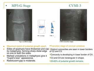 • MP3-G Stage CVMI-3
 Maximum point of pubertal growth spurt.
 Sides of epiphysis have thickened and cap
its metaphysis, forming sharp distal edge
on one or both the sides.
 Marked undulations in metaphysis give it
“Cupid’s bow’’ appearance.
 Radiolucent gap is moderate.
Transition stage of cervical vertebrae
Distinct concavities are seen in lower borders
of C2 and C3.
Concavity is developing in lower border of C4.
C3 and C4 are rectangular in shape.
25-65% of pubertal growth remains.
 