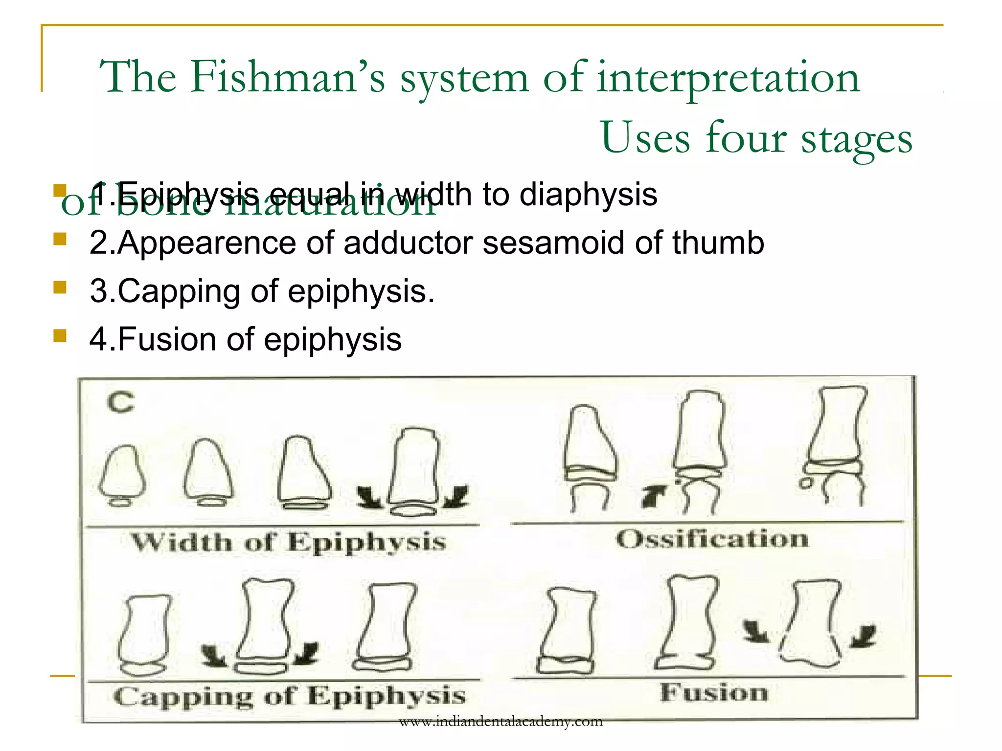 The Fishman’s system of interpretation
Uses four stages
of bone maturation 1.Epiphysis equal in width to diaphysis
 2.Appearence of adductor sesamoid of thumb
 3.Capping of epiphysis.
 4.Fusion of epiphysis
www.indiandentalacademy.com
 
