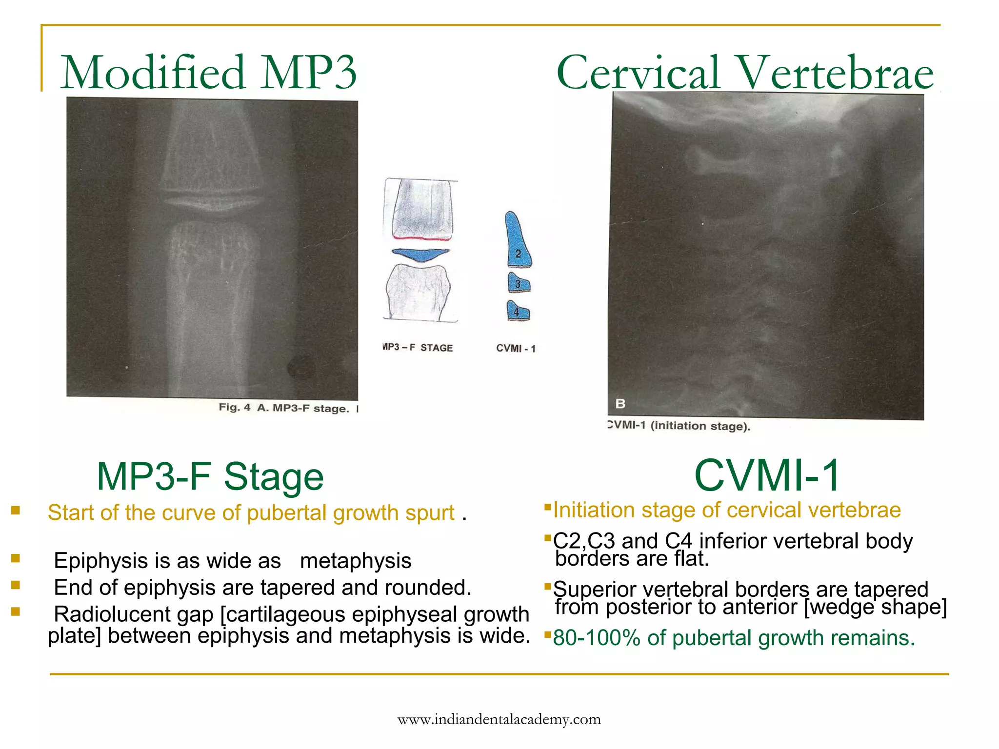 Modified MP3 Cervical Vertebrae
MP3-F Stage
 Start of the curve of pubertal growth spurt .
 Epiphysis is as wide as metaphysis
 End of epiphysis are tapered and rounded.
 Radiolucent gap [cartilageous epiphyseal growth
plate] between epiphysis and metaphysis is wide.
Initiation stage of cervical vertebrae
C2,C3 and C4 inferior vertebral body
borders are flat.
Superior vertebral borders are tapered
from posterior to anterior [wedge shape]
80-100% of pubertal growth remains.
CVMI-1
www.indiandentalacademy.com
 