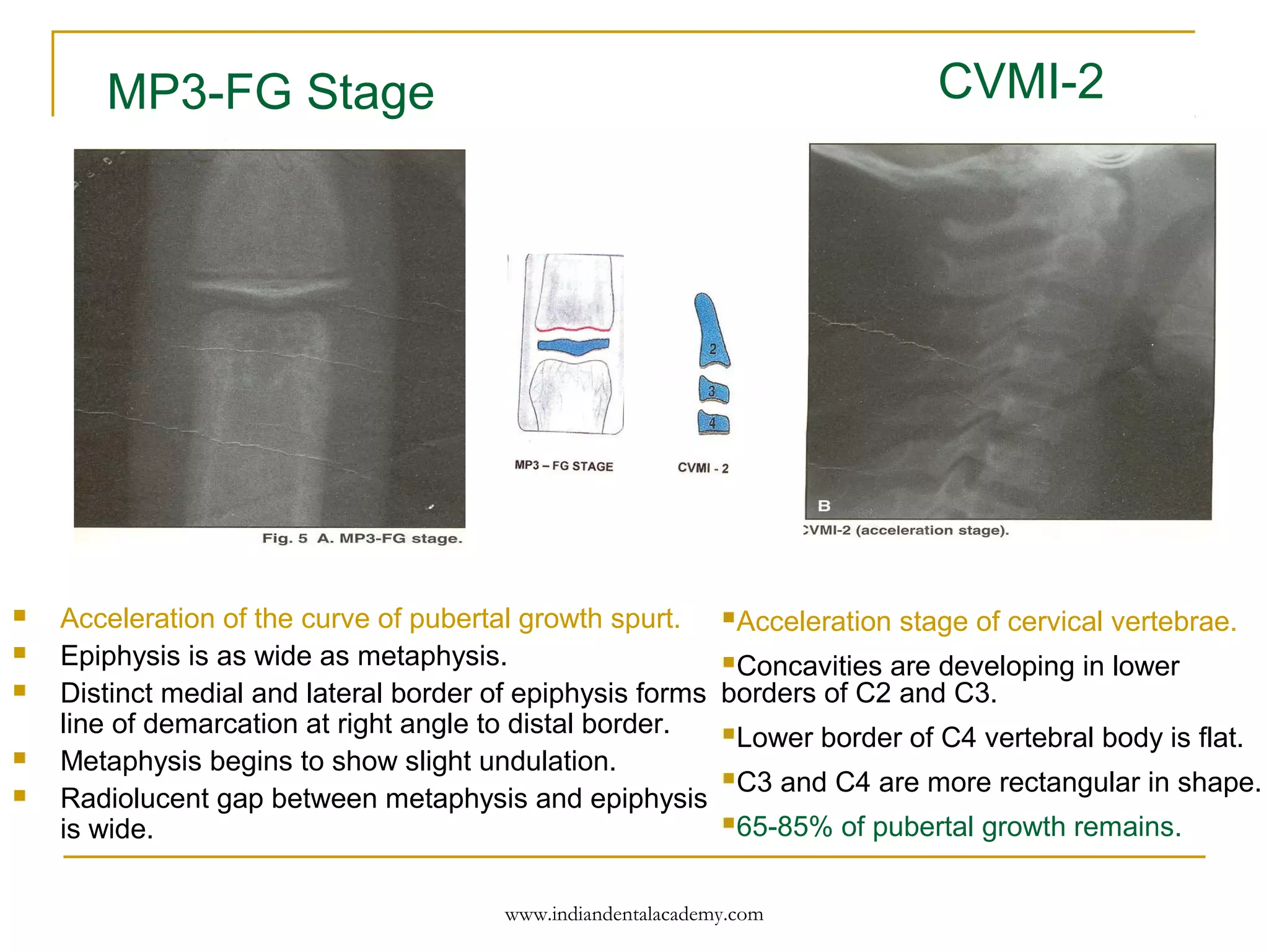  Acceleration of the curve of pubertal growth spurt.
 Epiphysis is as wide as metaphysis.
 Distinct medial and lateral border of epiphysis forms
line of demarcation at right angle to distal border.
 Metaphysis begins to show slight undulation.
 Radiolucent gap between metaphysis and epiphysis
is wide.
Acceleration stage of cervical vertebrae.
Concavities are developing in lower
borders of C2 and C3.
Lower border of C4 vertebral body is flat.
C3 and C4 are more rectangular in shape.
65-85% of pubertal growth remains.
MP3-FG Stage CVMI-2
www.indiandentalacademy.com
 