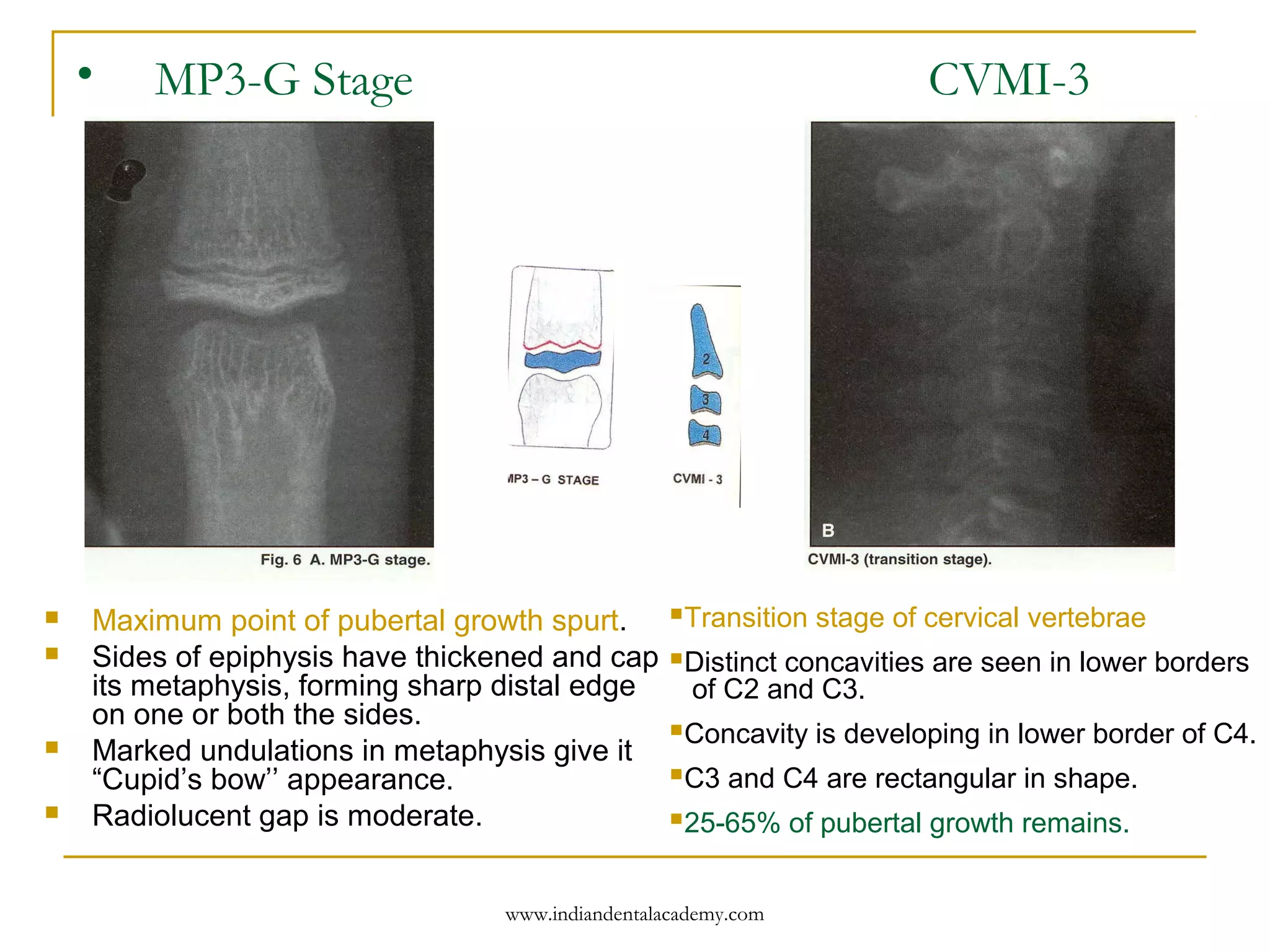 • MP3-G Stage CVMI-3
 Maximum point of pubertal growth spurt.
 Sides of epiphysis have thickened and cap
its metaphysis, forming sharp distal edge
on one or both the sides.
 Marked undulations in metaphysis give it
“Cupid’s bow’’ appearance.
 Radiolucent gap is moderate.
Transition stage of cervical vertebrae
Distinct concavities are seen in lower borders
of C2 and C3.
Concavity is developing in lower border of C4.
C3 and C4 are rectangular in shape.
25-65% of pubertal growth remains.
www.indiandentalacademy.com
 
