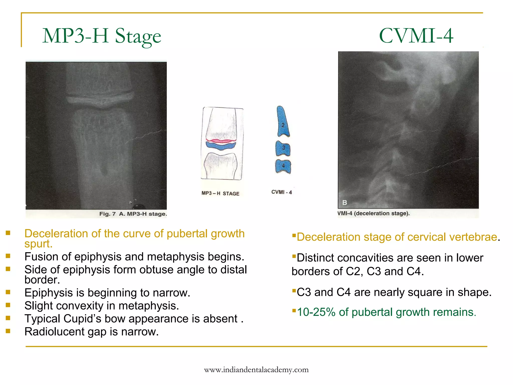 MP3-H Stage CVMI-4
 Deceleration of the curve of pubertal growth
spurt.
 Fusion of epiphysis and metaphysis begins.
 Side of epiphysis form obtuse angle to distal
border.
 Epiphysis is beginning to narrow.
 Slight convexity in metaphysis.
 Typical Cupid’s bow appearance is absent .
 Radiolucent gap is narrow.
Deceleration stage of cervical vertebrae.
Distinct concavities are seen in lower
borders of C2, C3 and C4.
C3 and C4 are nearly square in shape.
10-25% of pubertal growth remains.
www.indiandentalacademy.com
 