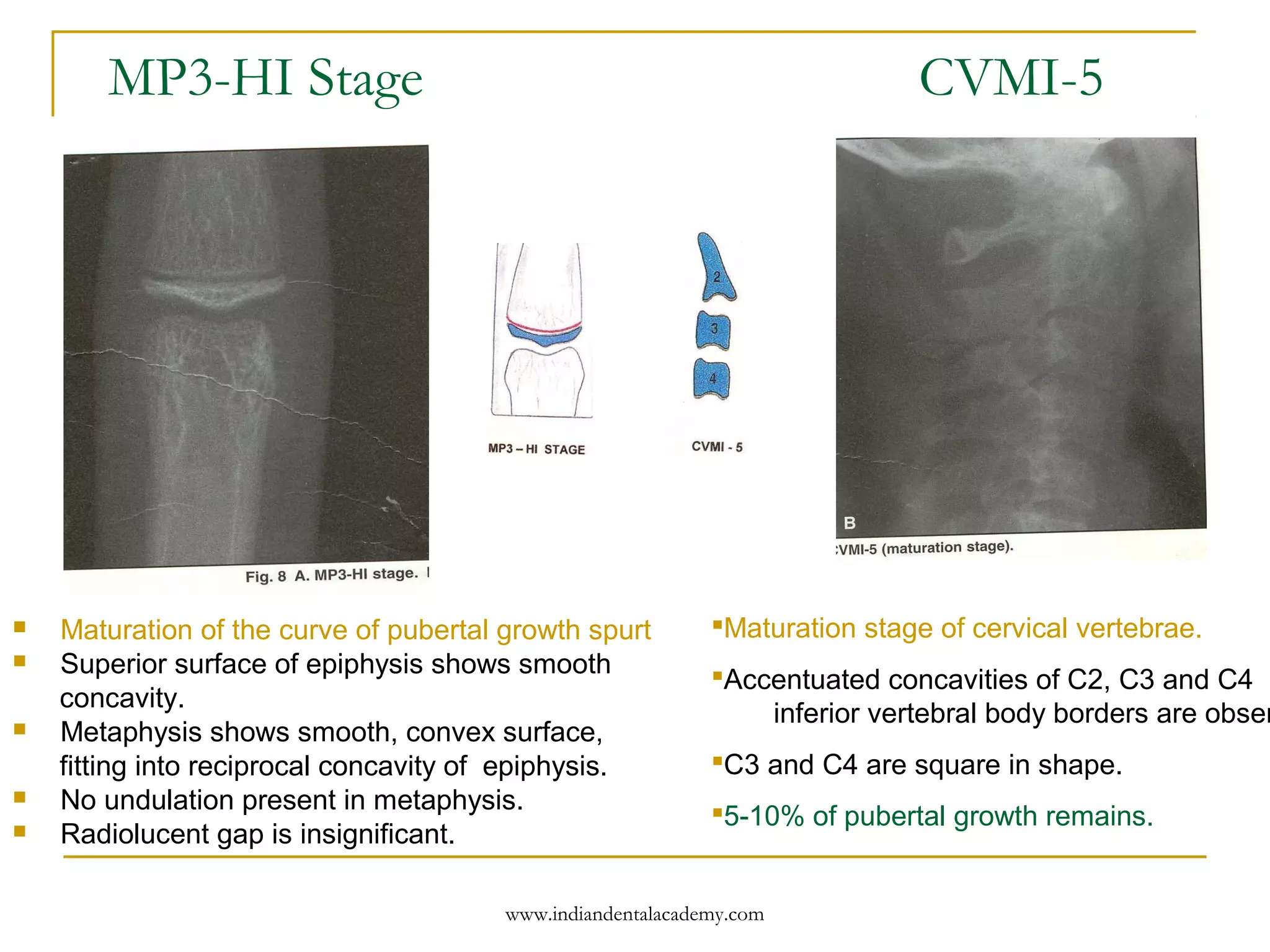 MP3-HI Stage CVMI-5
 Maturation of the curve of pubertal growth spurt
 Superior surface of epiphysis shows smooth
concavity.
 Metaphysis shows smooth, convex surface,
fitting into reciprocal concavity of epiphysis.
 No undulation present in metaphysis.
 Radiolucent gap is insignificant.
Maturation stage of cervical vertebrae.
Accentuated concavities of C2, C3 and C4
inferior vertebral body borders are obser
C3 and C4 are square in shape.
5-10% of pubertal growth remains.
www.indiandentalacademy.com
 