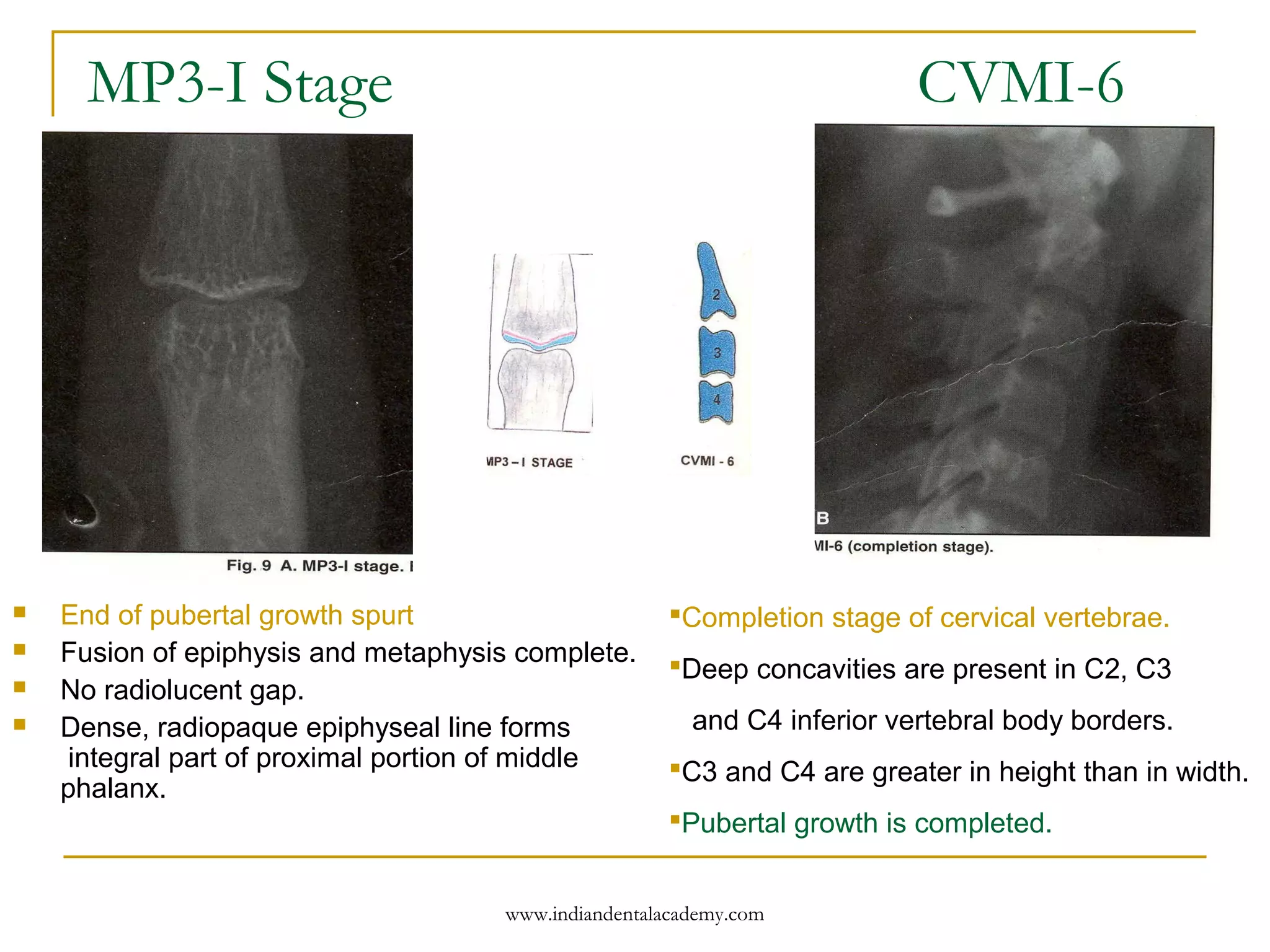 MP3-I Stage CVMI-6
 End of pubertal growth spurt
 Fusion of epiphysis and metaphysis complete.
 No radiolucent gap.
 Dense, radiopaque epiphyseal line forms
integral part of proximal portion of middle
phalanx.
Completion stage of cervical vertebrae.
Deep concavities are present in C2, C3
and C4 inferior vertebral body borders.
C3 and C4 are greater in height than in width.
Pubertal growth is completed.
www.indiandentalacademy.com
 