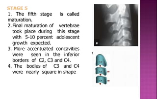 1. The fifth stage is called
maturation.
2.Final maturation of vertebrae
took place during this stage
with 5-10 percent adolescent
growth expected.
3. More accentuated concavities
were seen in the inferior
borders of C2, C3 and C4.
4. The bodies of C3 and C4
were nearly square in shape
 