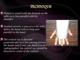 TECHNIQUE
Patient is seated with the forearm on the
table on a line parallel with his
shoulder
Loaded cassette is placed on the table,
below the hand with its long axis
parallel to the hand.
The central ray is directed
perpendicular to a line passing between
the hands and if only one hand is to be
radiographed, the central ray should be
directed at centre of the carpals.
 