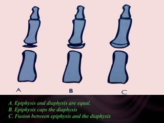 A.
A. Epiphysis and diaphysis are equal.
B. Epiphysis caps the diaphysis
C. Fusion between epiphysis and the diaphysis
 