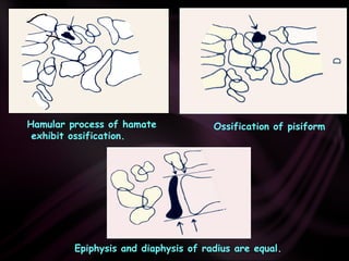 Epiphysis and diaphysis of radius are equal.
Hamular process of hamate
exhibit ossification.
Ossification of pisiform
 