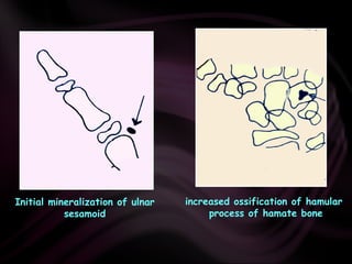 Initial mineralization of ulnar
sesamoid
increased ossification of hamular
process of hamate bone
 