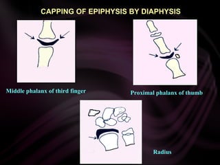 CAPPING OF EPIPHYSIS BY DIAPHYSIS
Middle phalanx of third finger Proximal phalanx of thumb
Radius
 