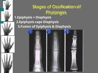Stages of Ossification of
Phalanges
1.Epiphysis = Diaphysis
2.Epiphysis caps Diaphysis
3.Fusion of Epiphysis & Diaphysis
1 2 3
 
