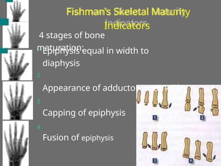 4 stages of bone
maturation:
1
2
3
4
Epiphysis equal in width to
diaphysis
Appearance of adductor sesamoid
Capping of epiphysis
Fusion of epiphysis
Fishman’s Skeletal Maturity
Indicators
 