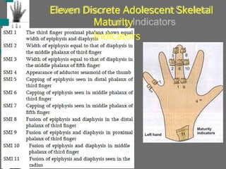 Eleven Discrete Adolescent Skeletal
Maturity
Indicators
 