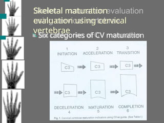 Skeletal maturation
evaluation using cervical
vertebrae
 Six categories of CV maturation
 