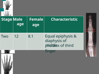 Stage Male Female
age
Characteristic
phalanx of third
finger
Two 12
age
8.1 Equal epiphysis &
diaphysis of
middle
 