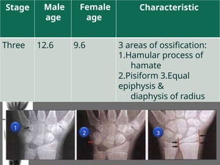 Stage Male
age
Female
age
Characteristic
1.Hamular process of
hamate
2.Pisiform 3.Equal
epiphysis &
diaphysis of radius
Three 12.6 9.6 3 areas of ossification:
1
2 3
 