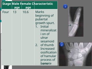 bone
Stage Male Female Characteristic
Four
age
13
age
10.6 Marks
beginning of
pubertal
growth spurt.
1. Initial
mineralizat
i on of
ulnar
sesamoid
of thumb
Increased
ossification
of hamular
process of
hamate
2. 2
1
 