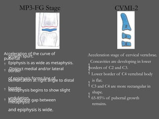 Acceleration of the curve of
pubertal
growth spurt.
Epiphysis is as wide as metaphysis.
Distinct medial and/or lateral
border
of epiphysis forms line of
demarcation at right angle to distal
border.
Metaphysis begins to show slight
undulation.
Radiolucent gap between
metaphysis
and epiphysis is wide.




Lower border of C4 vertebral body
is flat.
C3 and C4 are more rectangular in
shape.
65-85% of pubertal growth
remains.
Acceleration stage of cervical vertebrae.

Concavities are developing in lower



borders of C2 and C3.
MP3-FG Stage CVMI-2
 
