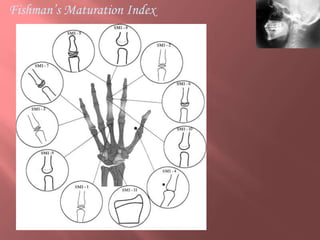 Skeletal Maturity indicators O.pptx