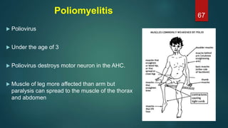 Poliomyelitis
 Poliovirus
 Under the age of 3
 Poliovirus destroys motor neuron in the AHC.
 Muscle of leg more affected than arm but
paralysis can spread to the muscle of the thorax
and abdomen
67
 