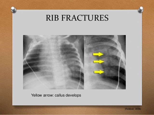 skeletal fractures pediatric metaphyseal