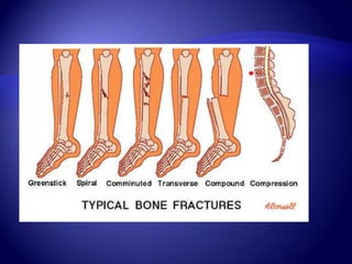 Isthereanytreatmentto relieve theirsymptoms?Bisphosphonates are the primary drugs used to both prevent and treat.Calcitonin is a medicine that slows the rate of bone loss and relieves bone pain.
